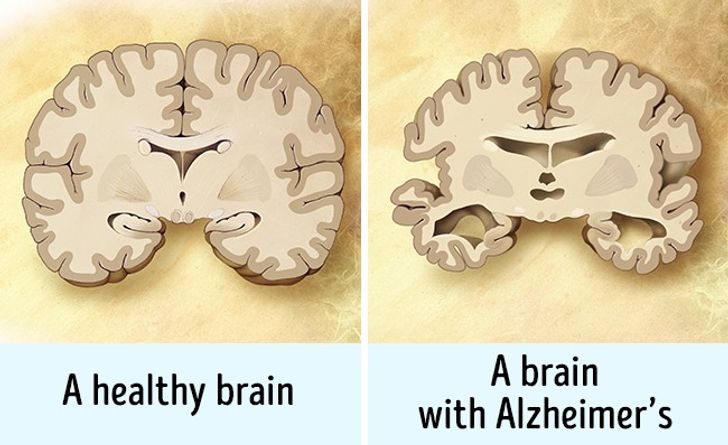 healthy brain vs a brain with alzheimer