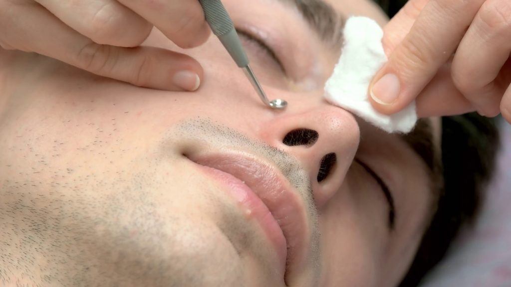 Face cleaning with blackhead remover