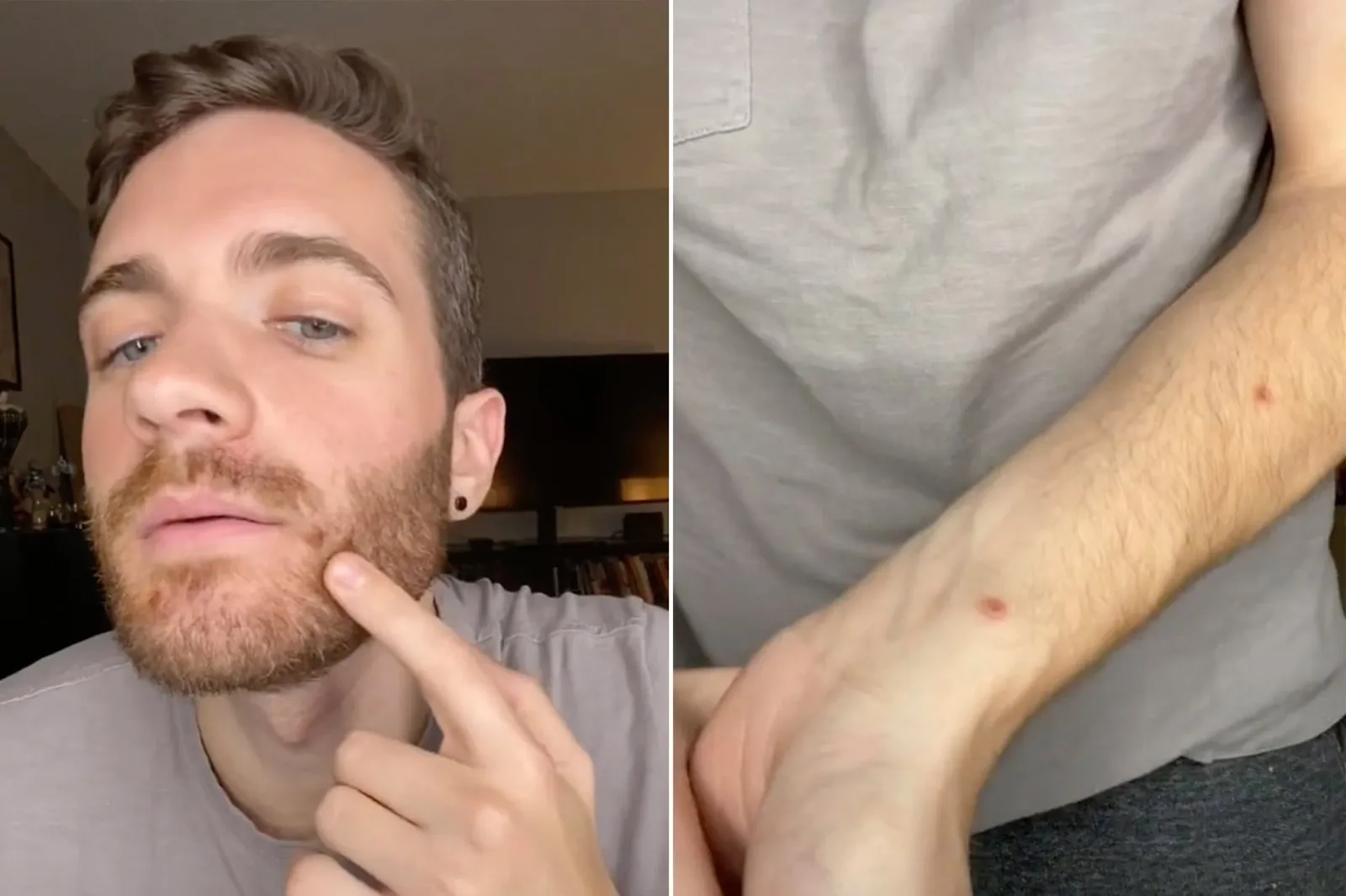 မျောက်ကျောက် ရောဂါ