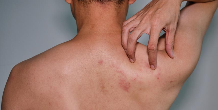 man pimple on back
