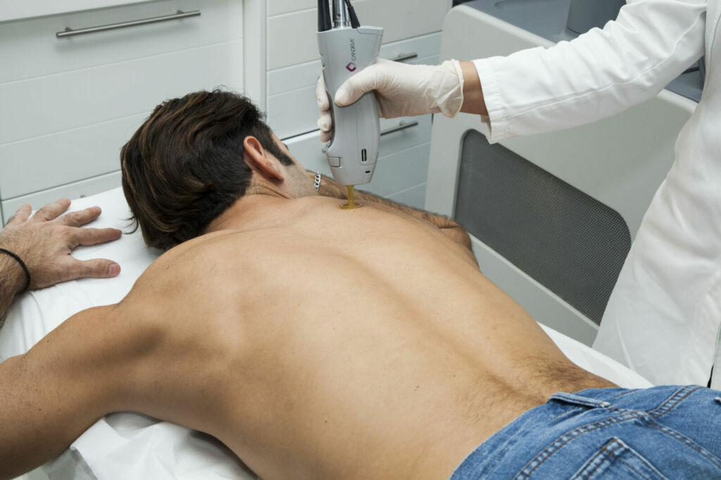 Laser hair removal 