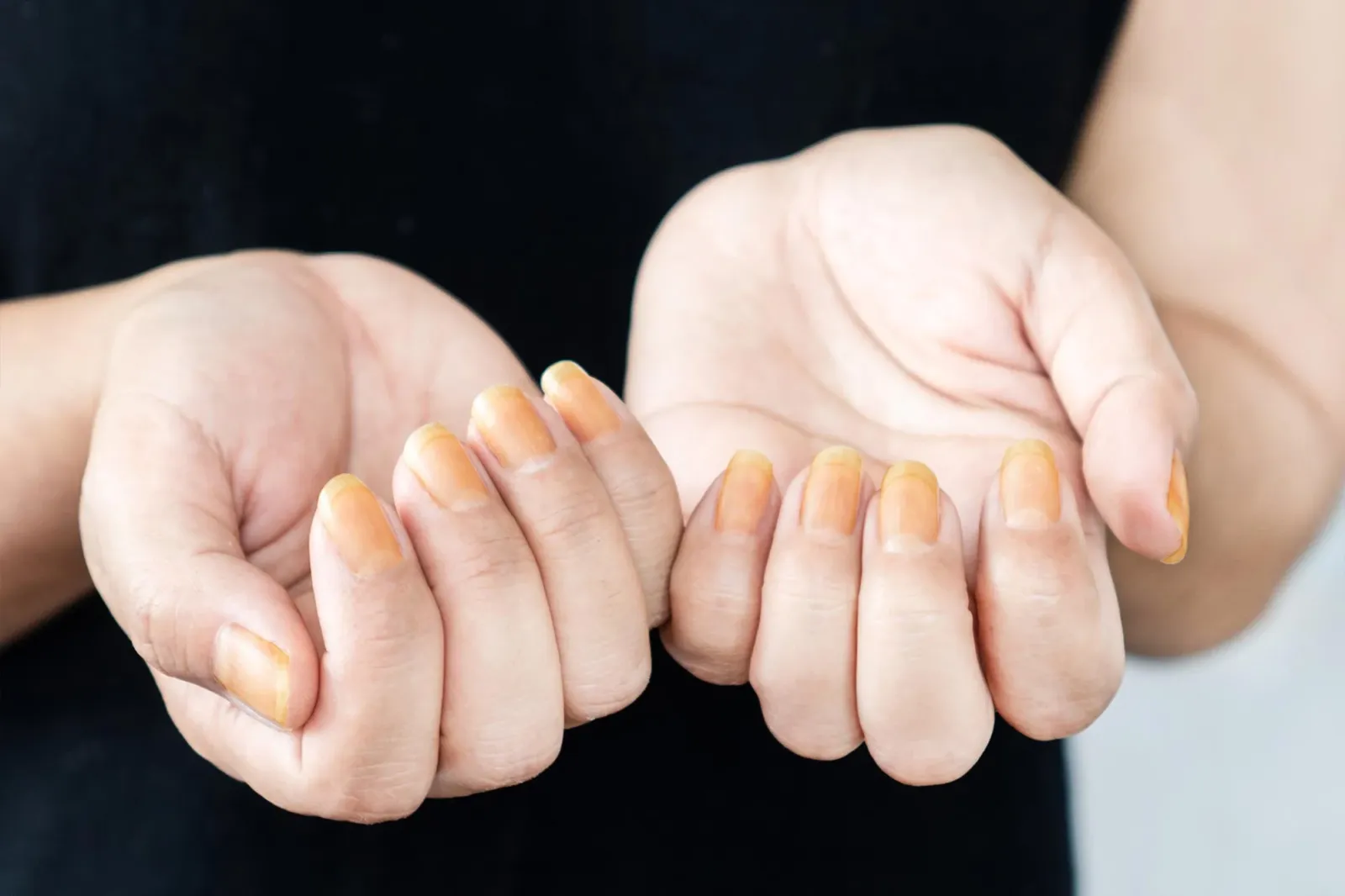 Yellow nail syndrome 