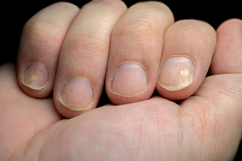 Yellow nail syndrome