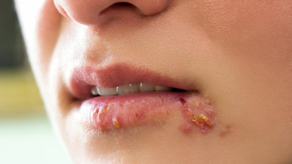Genital Herpes