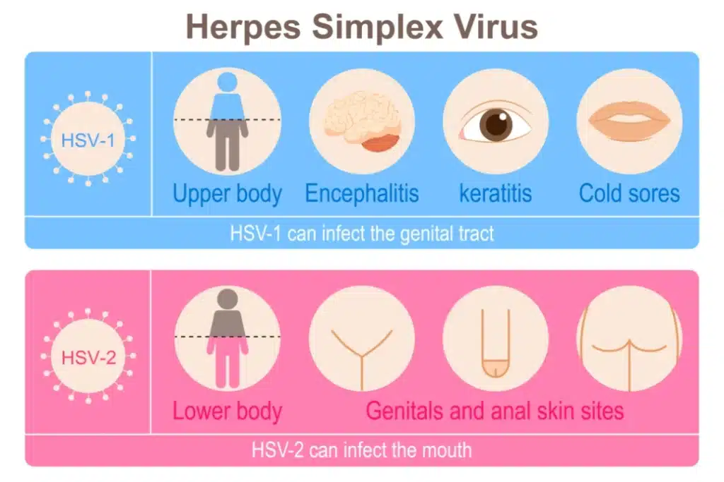 Genital Herpes 