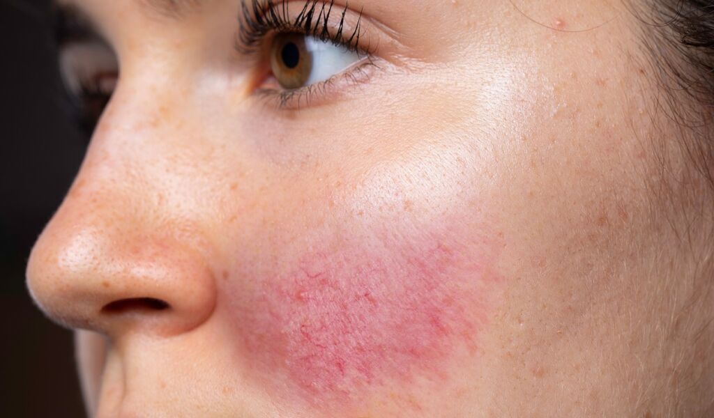 Allergic reactions 