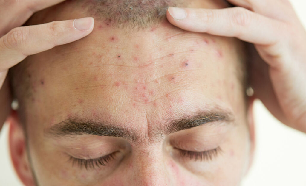 acne breakouts